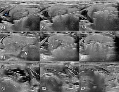 A prognostic model for thermal ablation of benign thyroid nodules based on interpretable machine learning